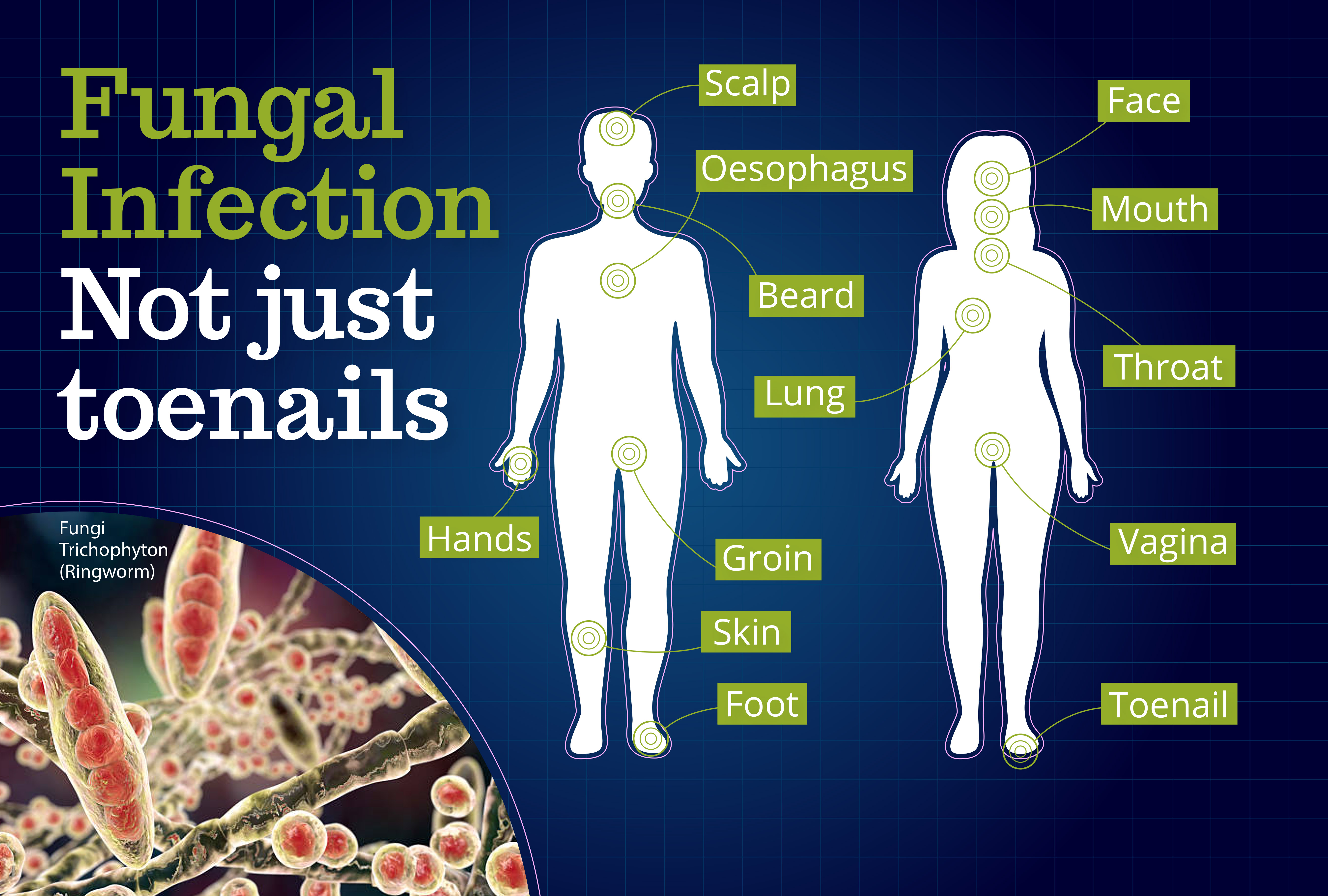 Skin Fungal Infection Medical Term