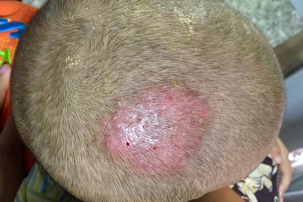 ringworm in humans scalp